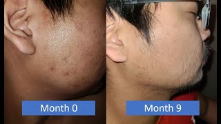 Minoxidil Beard Asian - Brother V2.0 (Month 9)
