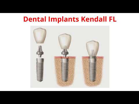 Miami Dental Group - Best Dental Implants in Kendall, FL