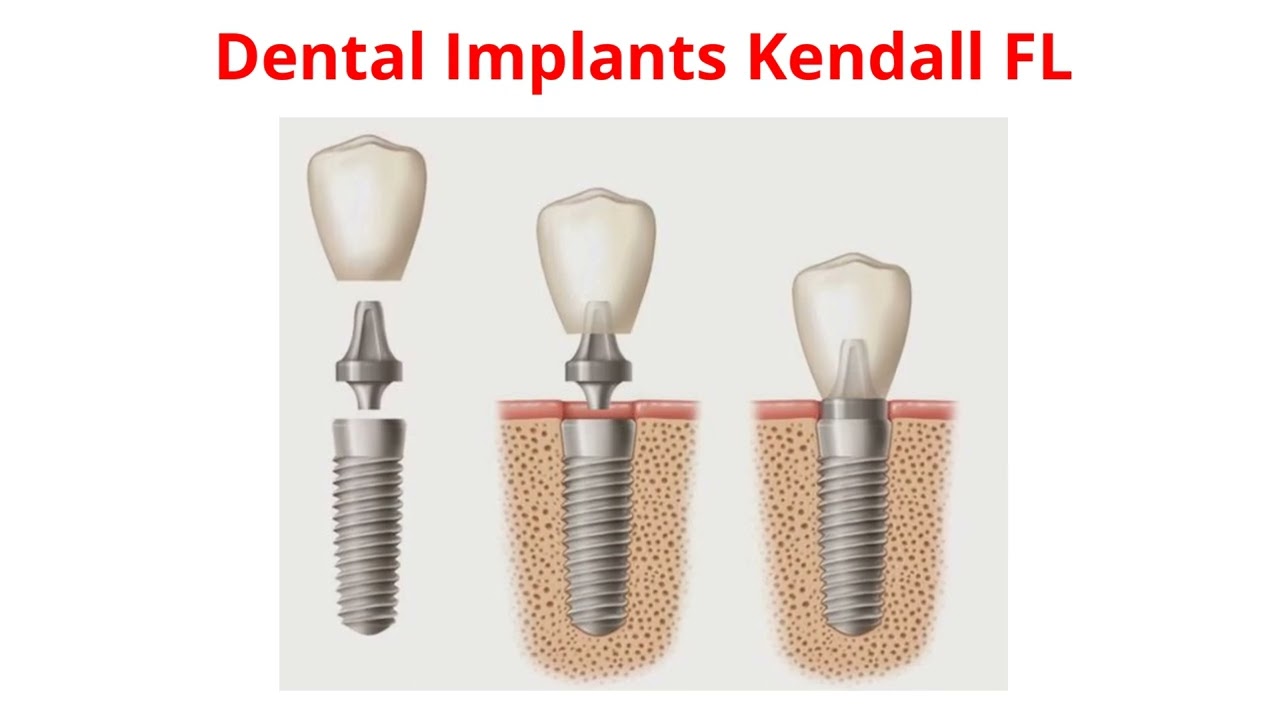Miami Dental Group - Best Dental Implants in Kendall, FL