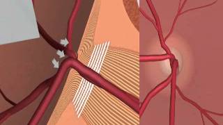 Glaucoma and Iridotomy treatment