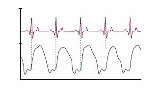 How the LV Waveform is Derived and LVEDP Calculated