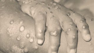 CDC tracking more suspected cases of monkeypox in the U.S.