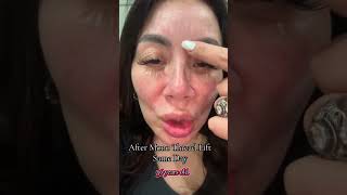 After Mono Thread Lift - Same Day - 56 years old
