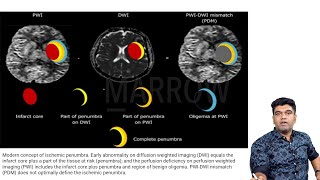 Management of Stroke | Edition 8 Sample Video (Medicine)