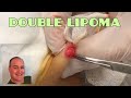 Lipoma Extraction Double Feature