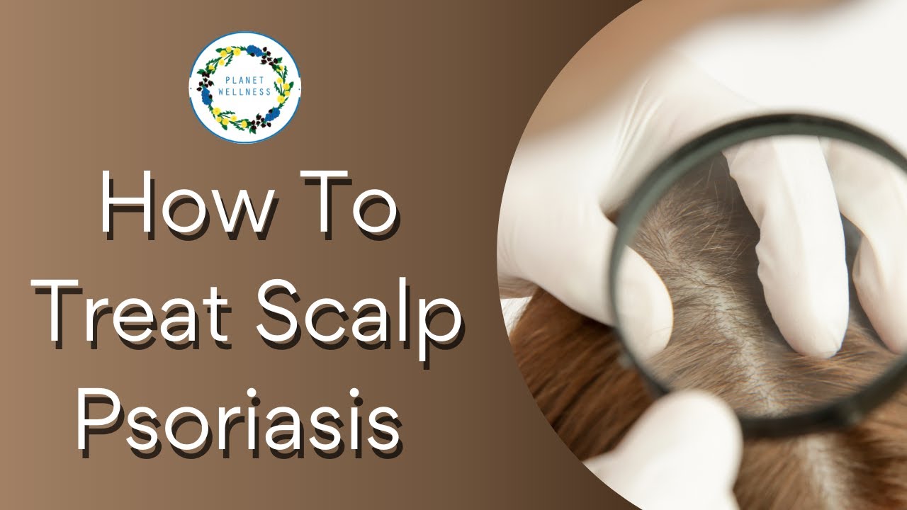 How To Treat Scalp Psoriasis Youtube
