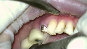 Cementation for metal casting post