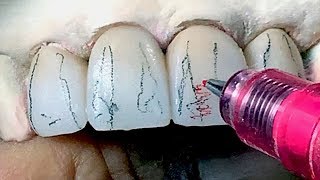 Tooth Morphology Design Techniques for Dental Lab Technicians