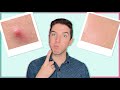How I Get Rid of a Pimple in One Day