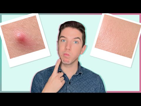 Video: 3 Ways to Get Rid of Melasma