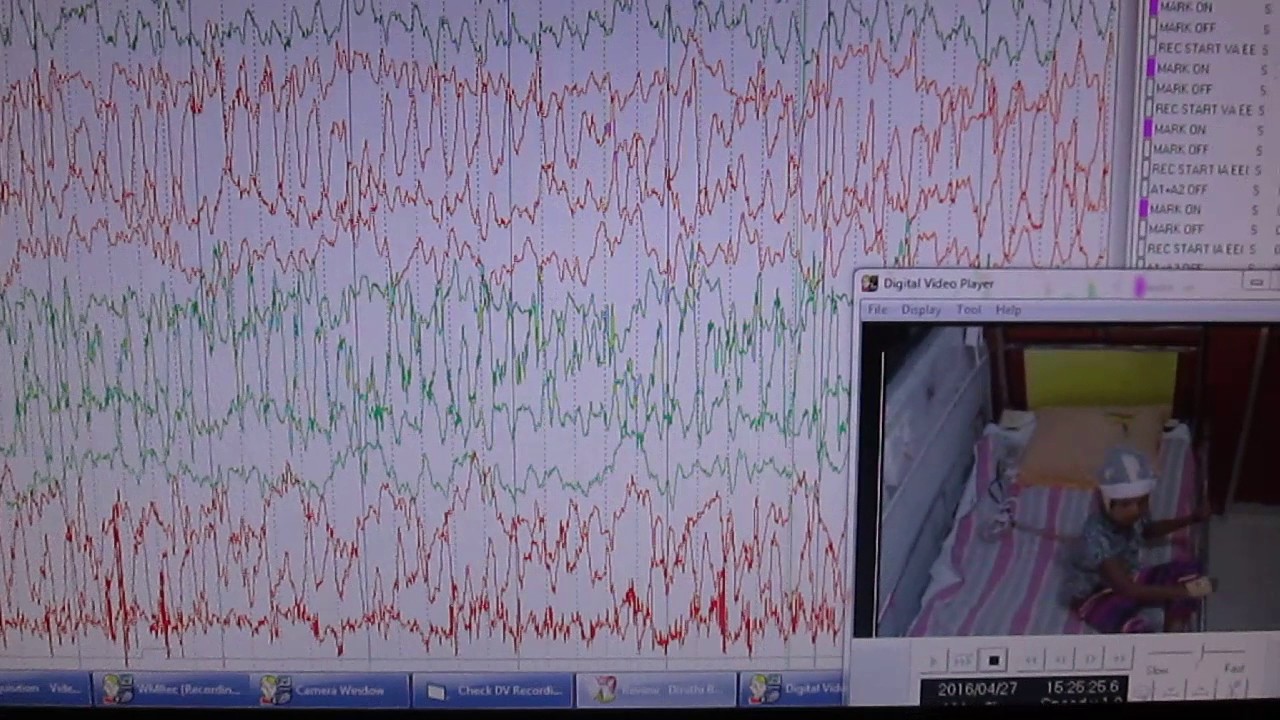 Epilepsy/Seizure/Fit Patent S Abnormal EEG record with Vedio - YouTube