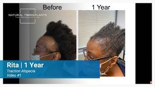 1 Year Traction Alopecia Hair Transplant Results | Dr. Blumenthal (Rita)