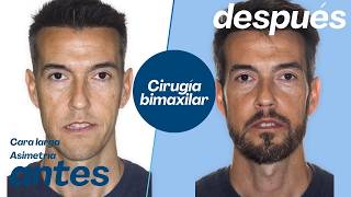 Cirugía bimaxilar Caso #176: Daniel- Clase III, Cara larga, Mordida cruzada