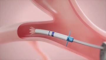 How It Works: Zephyr Endobronchial Valve