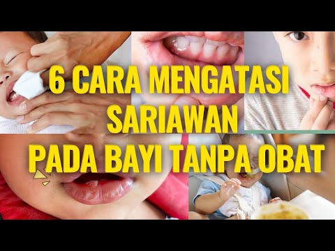 Video: 3 Cara Menghilangkan Sariawan pada Bayi