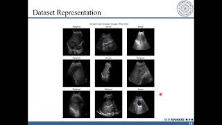 Lung Segmentation using AI