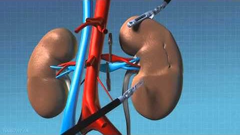 DaVinci Robotic Surgical System - Partial Nephrectomy Animation
