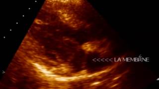 COR - TRIATRIATUM  SINISTER - ECHOCARDIOGRAPHY SERIES BY DR. ANKUR K. CHAUDHARI.