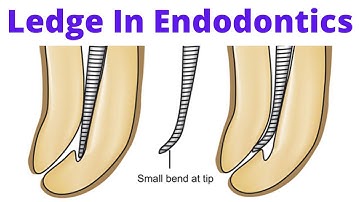 Ledge in Endodontics Root Canal- What, Causes, Prevention, Removal, Bypass and Management