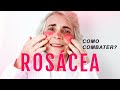 ROSÁCEA: O que é? Como cuidar? Qual o Tratamento? Dicas como combater e ficar livre!