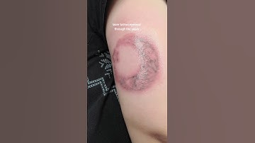 the day I got the tattoo and then 7 laser tattoo removal sessions later. tattoo update!