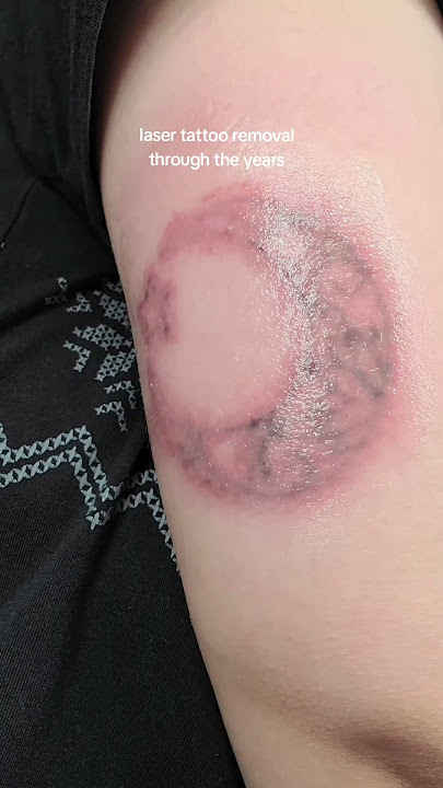 the day I got the tattoo and then 7 laser tattoo removal sessions later. tattoo update!