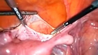 Total Laparoscopic Hysterectomy - M.D. Onder Koc
