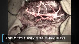 이하선 종향 - 수술치료 -