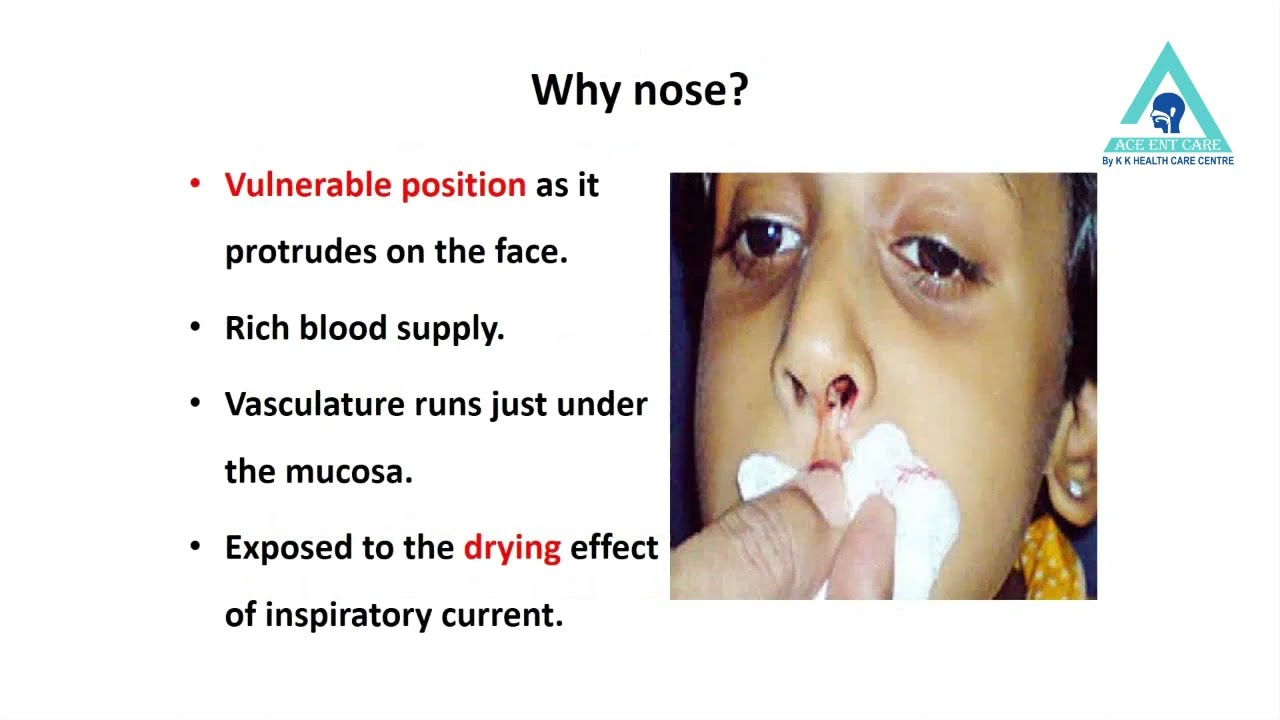 Epistaxis Nasal Bleed Part 1 YouTube Epistaxis Nasal Bleed Part 1 YouTube