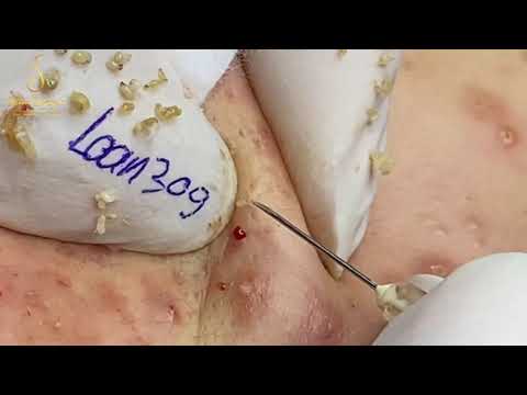BLACKHEADS REMOVAL (309_1) | Loan Nguyen