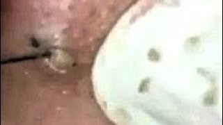 Best Blackhead Removal Ever 55min - Facial Acne Treatment