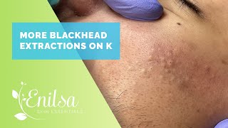 More Blackhead Extractions with K