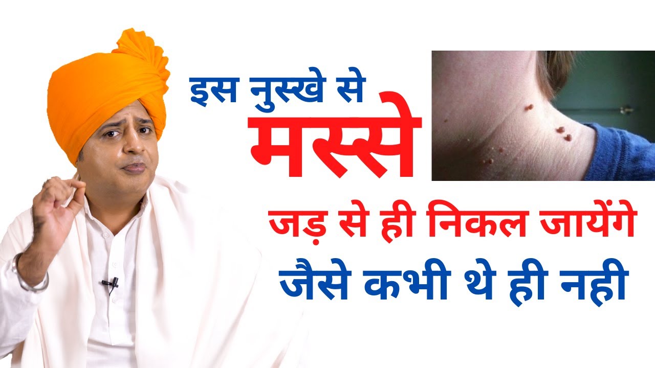 मस्से जड़ से ख़त्म करने के लिए How to Remove Warts Permanently || Sanyasi Ayurveda ||