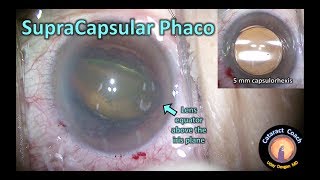 SupraCapsular Phaco Technique for Cataract Surgery with a Soft Nucleus screenshot 2