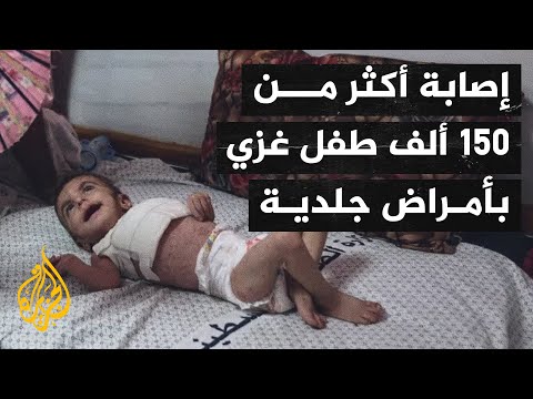أصوات من غزة| أطفال غزة يعانون انتشار الأمراض في ظل استمرار الحصار