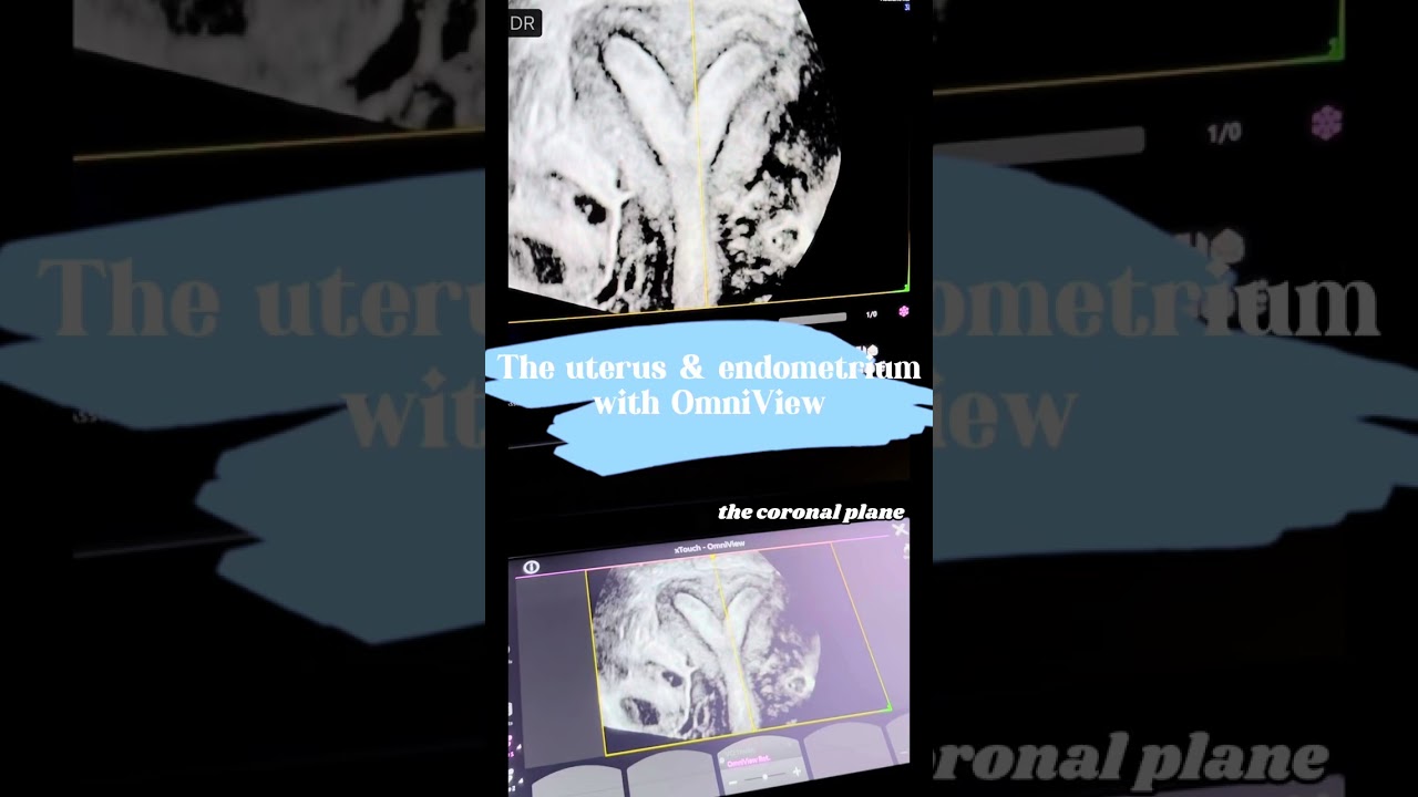 Evaluating using OmniView on GE Voluson Expert 22 ￼