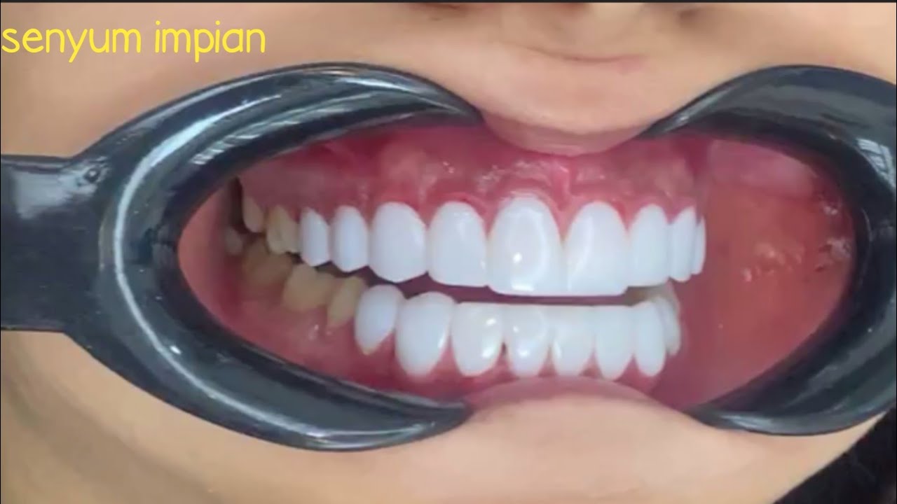 Tampil keren dengan gigi baru,senyum jadi terlihat indah - YouTube