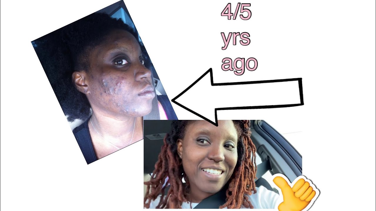 WHAT I DID TO GET RID OF MY CYSTIC ACNE - YouTube