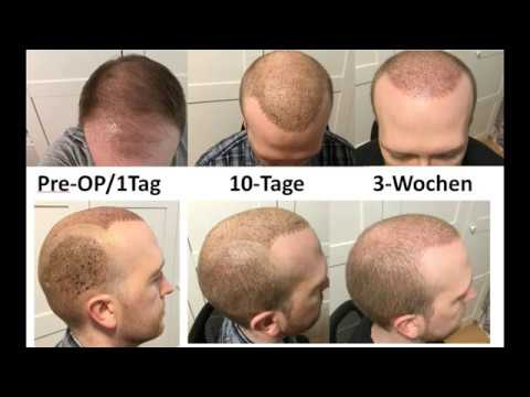 5 4 monaten nach haartransplantation Haarverpflanzung FAQ`s