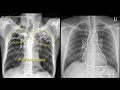 Chest  x ray  -   Tuberculosis healed,  (TB),   Inactive TB