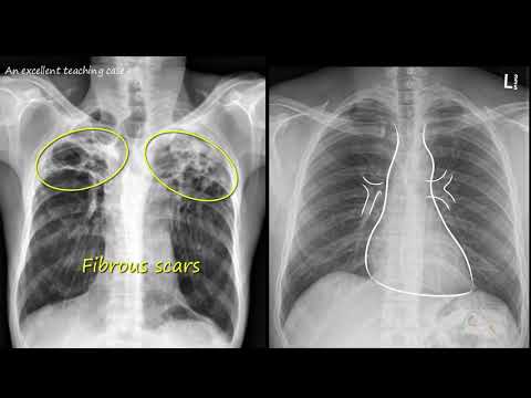 Video: Paano Magbasa ng isang Chest X Ray (na may Mga Larawan)