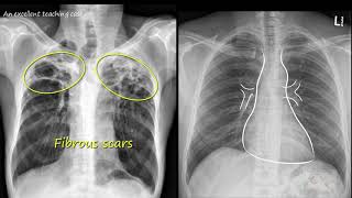 Chest  x ray  -   Tuberculosis healed,  (TB),   Inactive TB screenshot 2