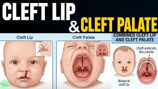 Cleft Lip and Cleft Palate: Embryology, Clinical Features, Diagnosis, and Management