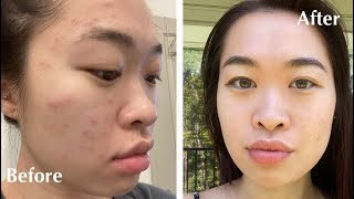 Clear Acne Flare Up in a Week! | Peach & Lily, Corsx, Micellar Water