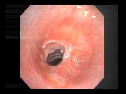 Broncoscopia - Estenose laringotraqueal
