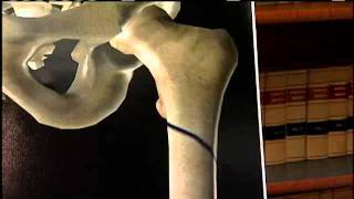 Hawaii Woman Blames Drug For Fracture