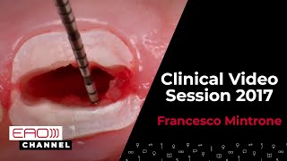 Francesco Mintrone Clinical Video Session 2017