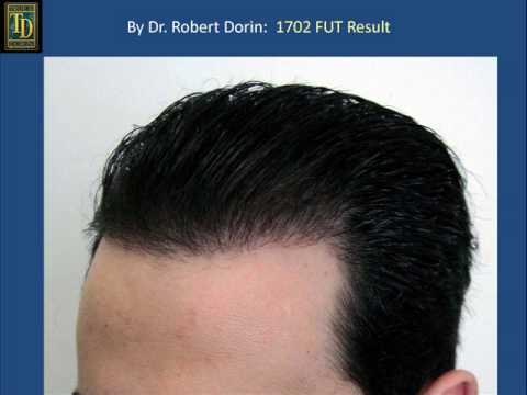 Tom Brady Hair Transplant - Esthetic Hair Mexico