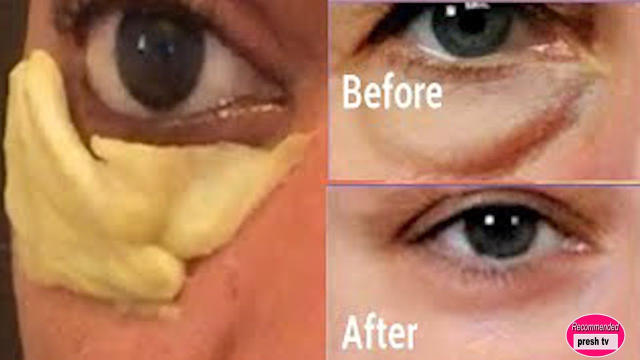 How to Remove Under Eye WRINKLES with ONION, Under Eye Bags, Puffy eyes