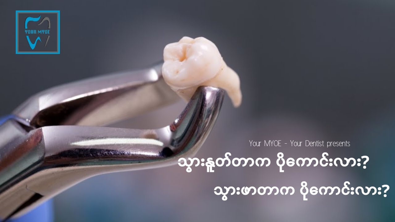 သွားနာတဲ့အခါ သွားနူတ်တာက ကောင်းလား? သွားဖာတာ ကောင်းလား?